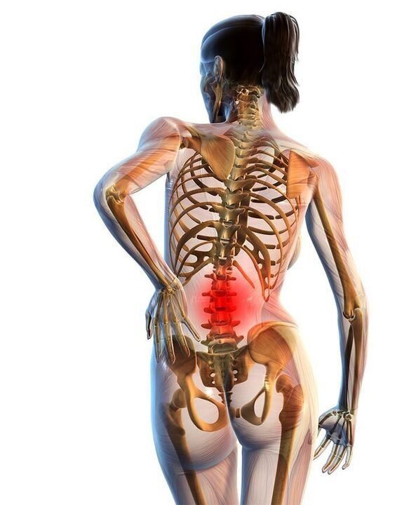 L'osteocondrosi della colonna lombare è la più comune