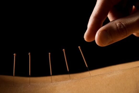 L'agopuntura aiuta a sbarazzarsi del dolore lombare