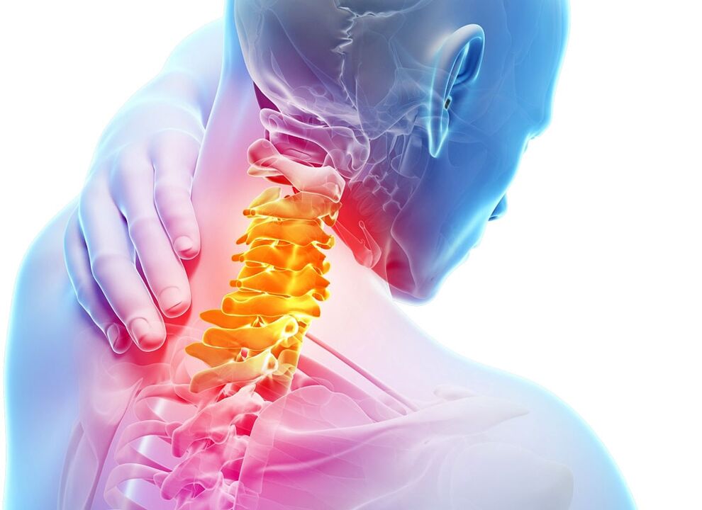 Sintomi dell'osteocondrosi cervicale
