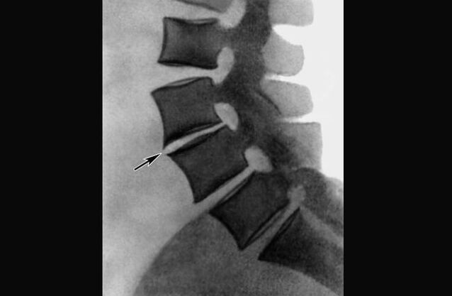 Manifestazioni di osteocondrosi della colonna vertebrale toracica alla radiografia
